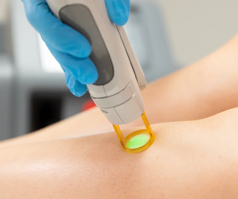 Epilation laser